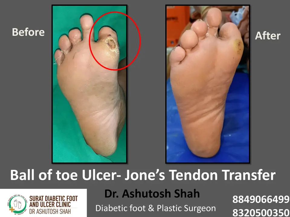 Diabetic Foot  PPT 3 checked by sir.pptx-28.webp